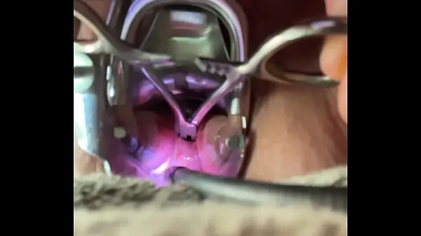 Najboljši Dilating cervix with hemastats painfully mega posnetki